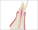 歯周ポケット深さの測定の図