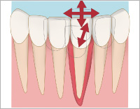歯の動揺の診査の図