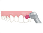 歯垢の付着状態の診査と染色の図